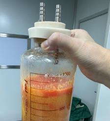 福安水动力吸脂手术要做多久？